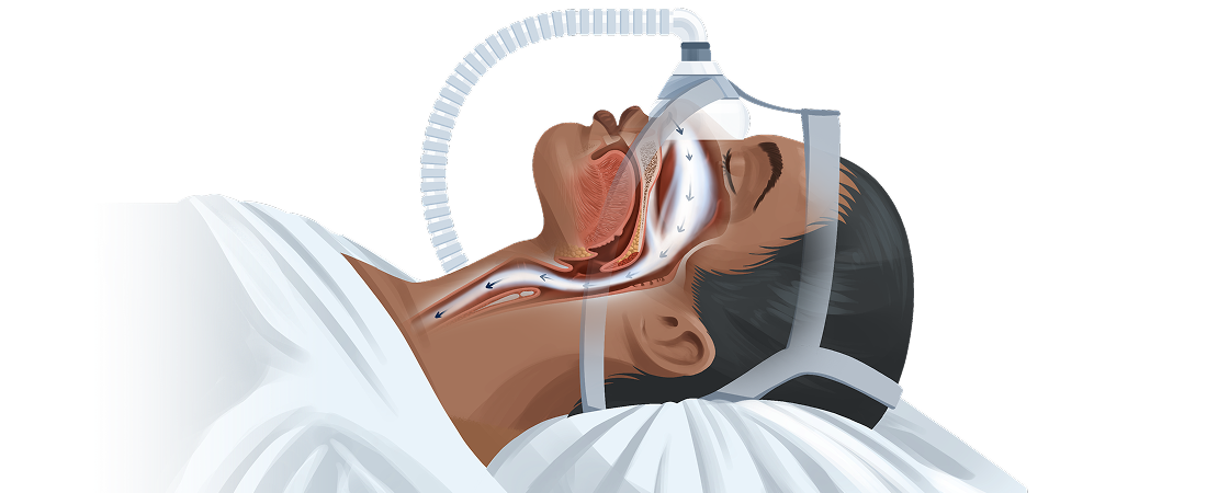 Syndrome d’apnées du sommeil (SAHOS)
