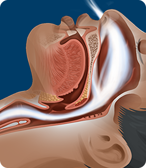 Illustration anatomique de profil montrant le passage de l'air libéré dans la gorge d'un patient endormi, grâce à l'effet de la pression positive continue.