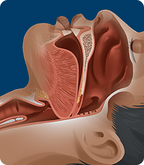 Illustration anatomique de profil d'un patient endormi montrant une obstruction des voies aériennes supérieures par la langue et le voile du palais.